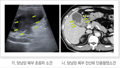 담낭암 복부 초음파 소견/담낭암 복부 전산화 단층 촬영 소견