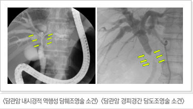 담관암 내시경적 역행성 담췌조영술 소견/담관암 경피경간 담도조영술 소견