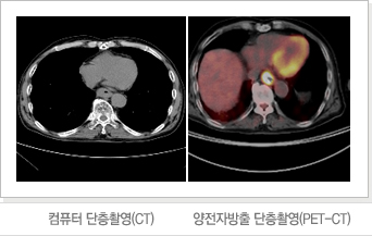 컴퓨터 단층촬영(CT)/양전자방출 단층촬영(PET-CT)