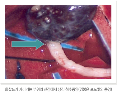 화살표가 가리키는 부위의 신경에서 생긴 척수종양(검붉은 포도빛의 종양)