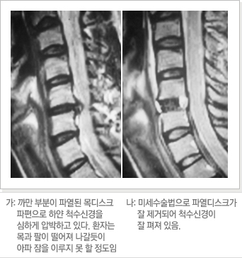 가: 까만 부분이 파열된 목디스크 파편으로 하얀 척수신경을 심하게 압박하고 있다. 환자는 목과 팔이 떨어져 나갈듯이 아파 잠을 이루지 못 할 정도임. 나: 미세수술법으로 파열디스크가 잘 제거되어 척수신경이 잘 펴져 있음.