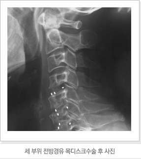 세 부위 전방경유 목디스크수술 후 사진