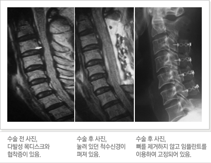 수술 전 사진, 다발성 목디스크와 협착증이 있음./수술 후 사진, 눌려 있던 척수신경이 펴져 있음./수술 후 사진, 뼈를 제거하지 않고 임플란트를 이용하여 고정되어 있음.
