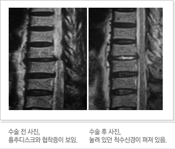수술 전 사진, 흉추디스크와 협착증이 보임. /수술 후 사진, 눌려 있던 척수신경이 펴져 있음. 