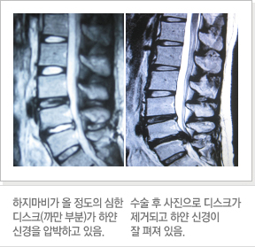하지마비가 올 정도의 심한 디스크(까만 부분)가 하얀 신경을 압박하고 있음./수술 후 사진으로 디스크가 제거되고 하얀 신경이 잘 펴져 있음.