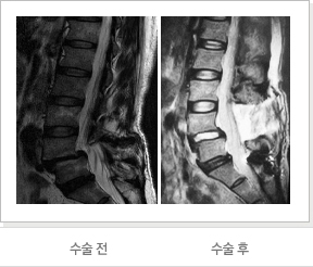수술 전/수술 후