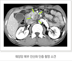 췌장암 복부 전산화 단층 촬영 소견
