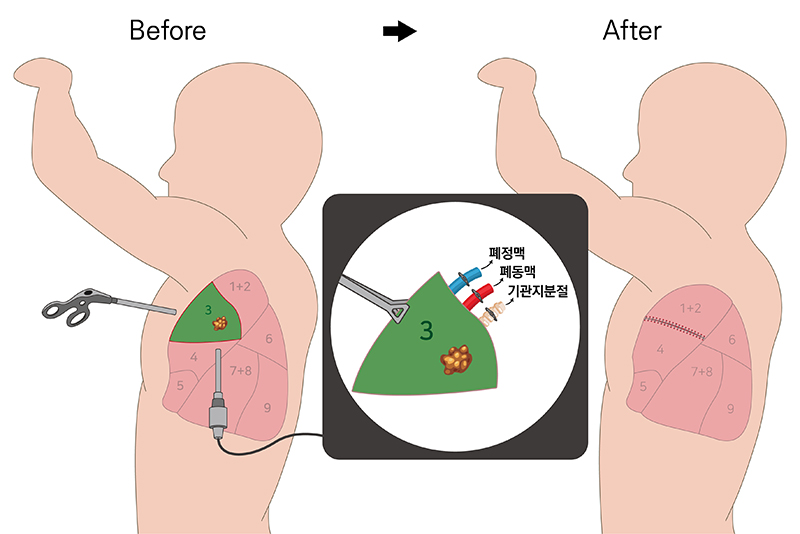 폐암수술의 진화, ICG 이용, 정확하게 최소 절제