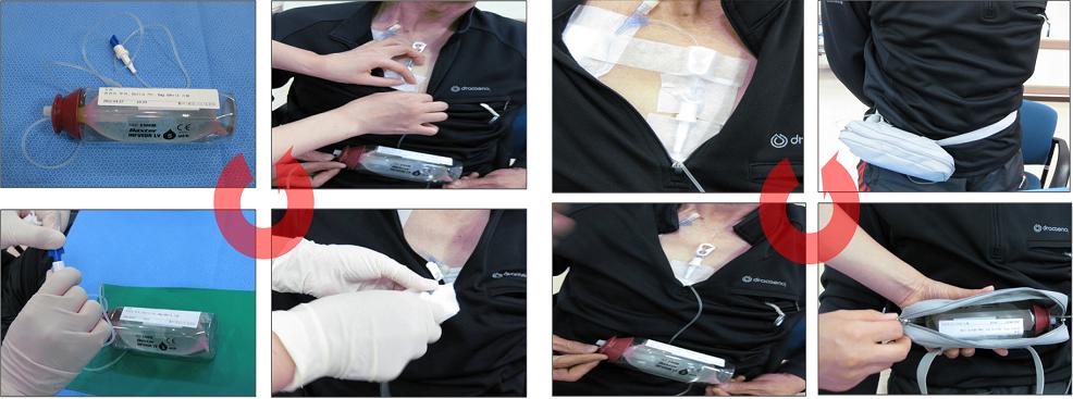 항암약물치료 집에서 받으세요~ 