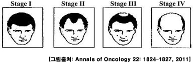 대머리 남성이 전립선암에 더 많이 걸린다?