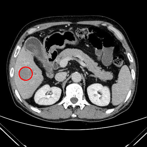 당뇨 때문에 간암 발견, 정기적 초음파 도움
