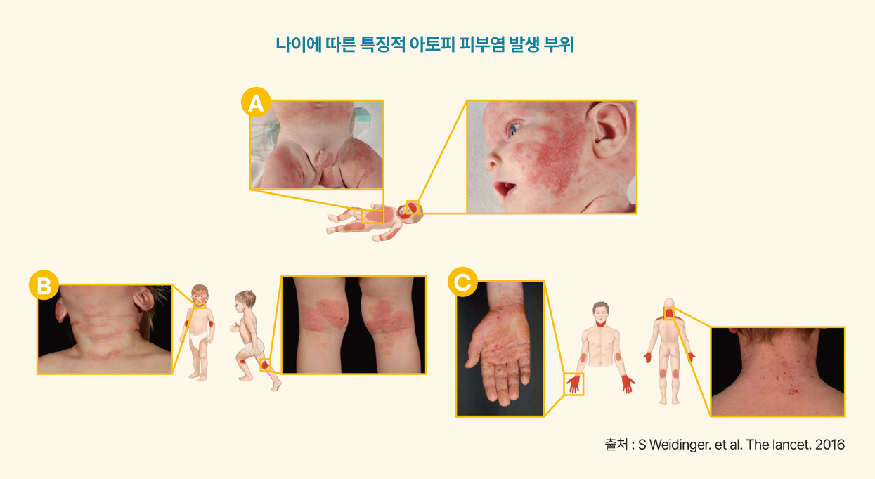 나이에 따른 특징적 아토피 피부염 발생 부위, 출처 : S Weidinger. et al. The lancet. 2016