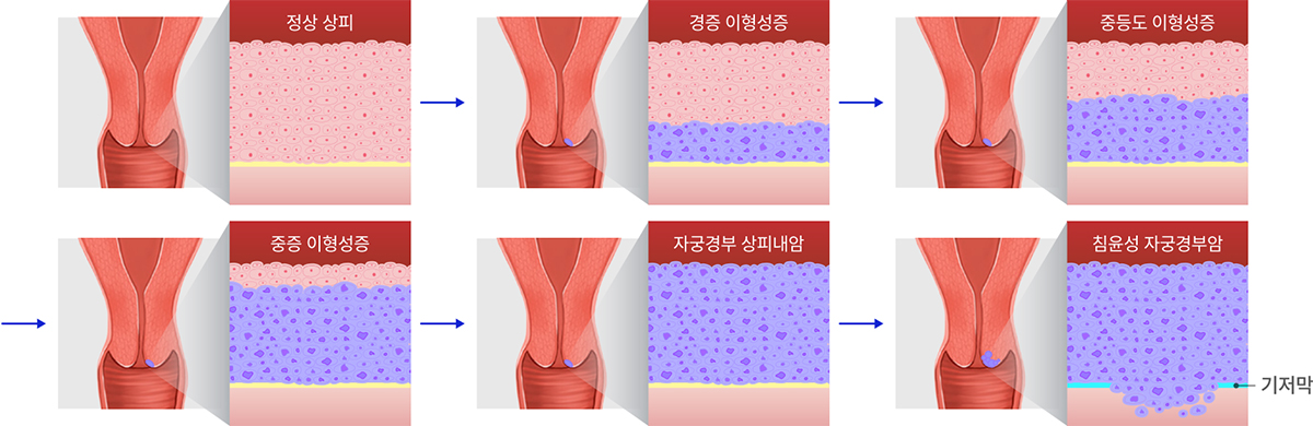 1. 정상 상피, 2. 경증 이형성증, 3. 증등도 이형성증, 4. 중증 이형성증, 5. 자궁경부 상피내암, 6. 침윤성 자궁경부암 (기저막)