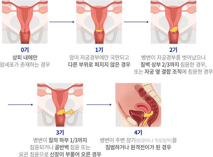 자궁경부암의 진행 단계 절차표