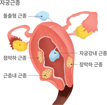 자궁근종, 돌출형 근종, 점막하 근종, 자궁강내 근종, 근층내 근종, 장막하 근종
