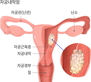 주궁내막암, 자궁관(난관), 난소, 자궁근육층, 자궁내막, 자궁경부, 질