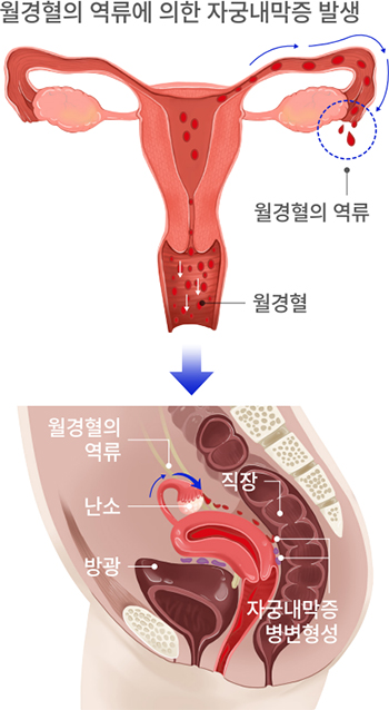 월경혈의 역류, 월경혈, 월경혈의 역류, 난소, 방광, 직장, 자궁내막증 병변형성
