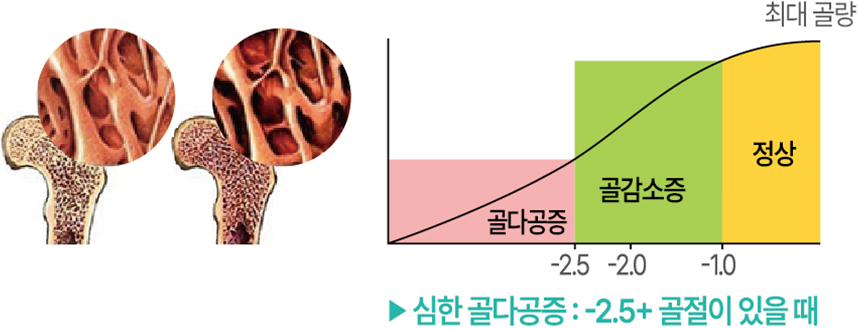 골다공증의 증상 및 진단을 설명하는 사진