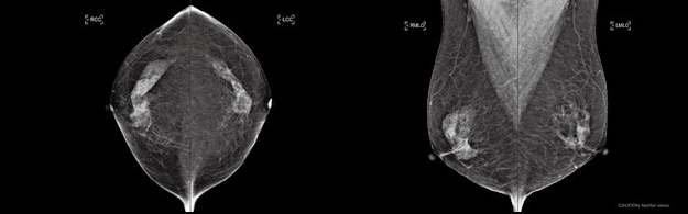 정상 유방 영상 사진