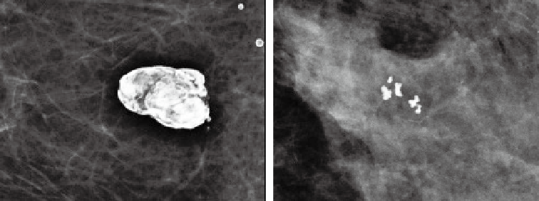 양성 석회화의 특징 사진