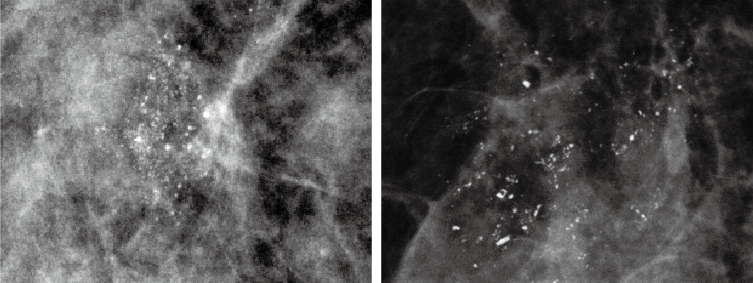 미세 석회화의 특징 사진