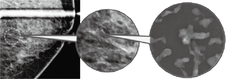  입체적 정위 생검술(STX : Stereotactic Biopsy) 사진