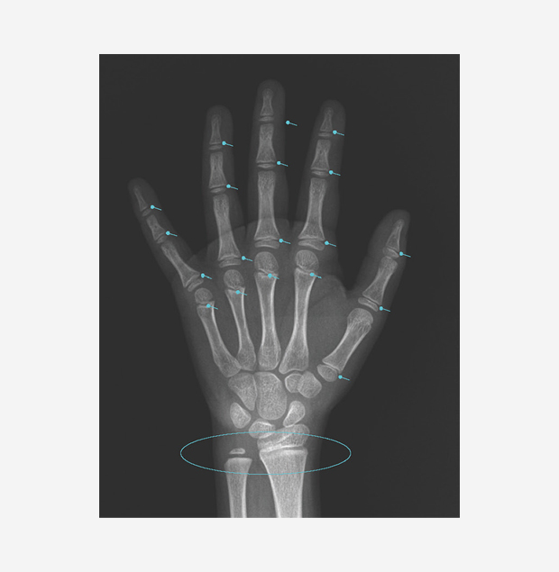사춘기 전 손 X-ray